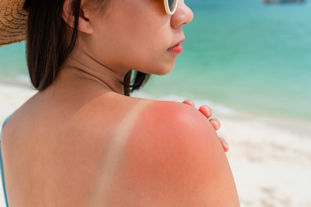 Frau mit Sonnenbrand auf der Schulter am Strand, sichtbare helle Bikini-Abdrucke, als Hinweis auf unzureichenden Sonnenschutz.